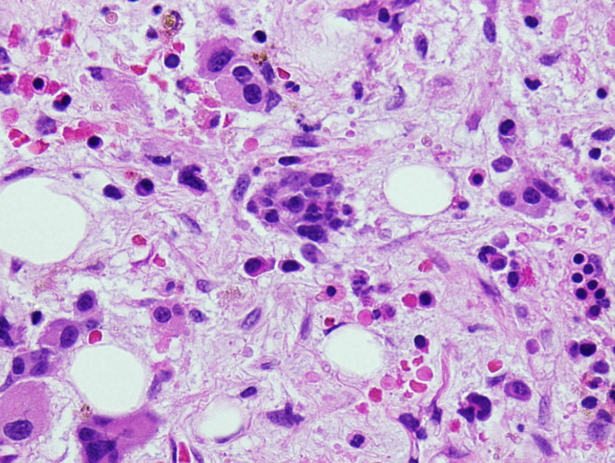 Bone marrow biopsy 40x